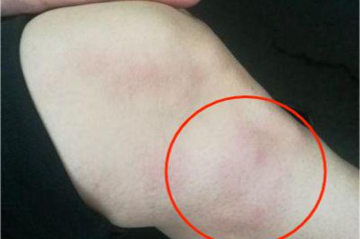 膝盖处风湿病小红点图