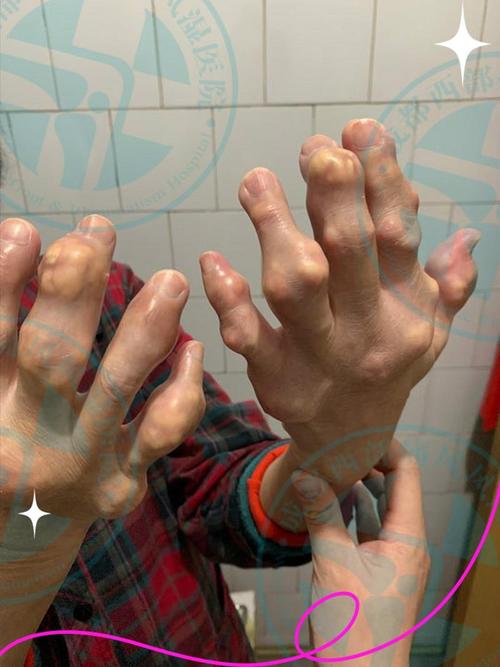 西安五院看风湿怎么样