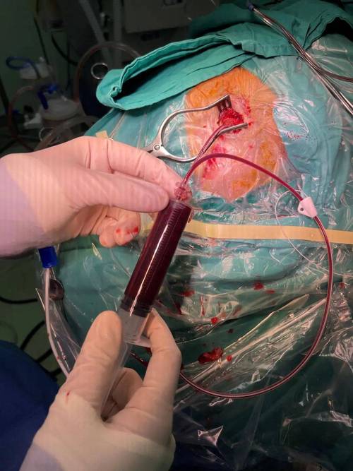 大面积脑梗手术成功率