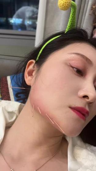 下巴的穴位怎样进针