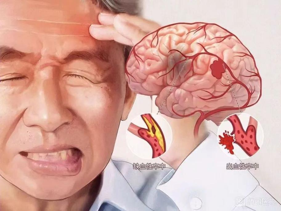 脑梗的人感觉四肢无力