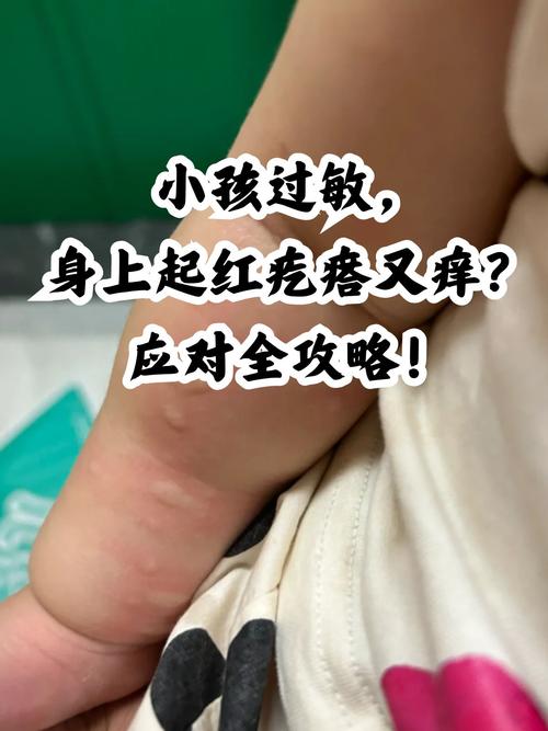 宝宝身上起风湿怎么办