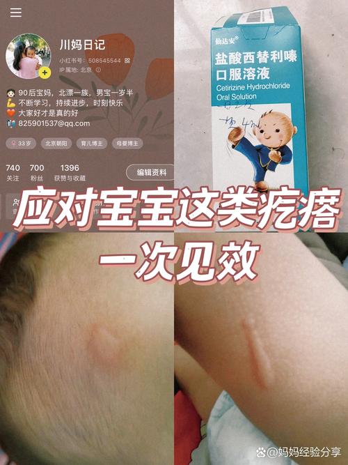 宝宝身上起风湿怎么办