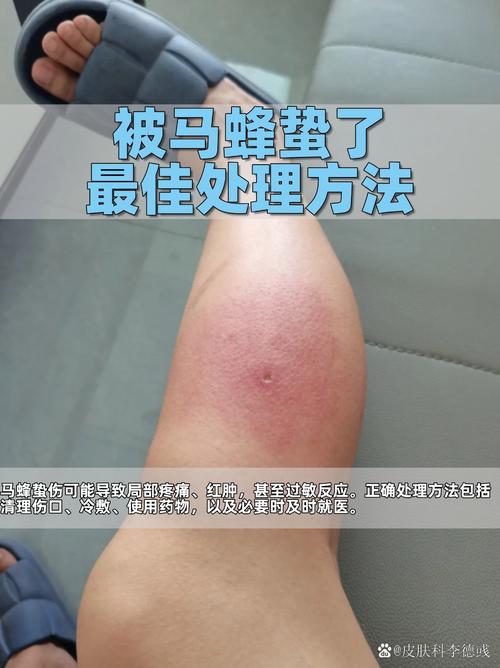 类风湿用蜂子能蛰好吗