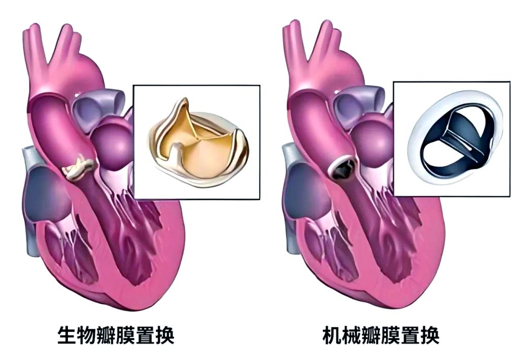 风湿性心脏瓣膜置换术