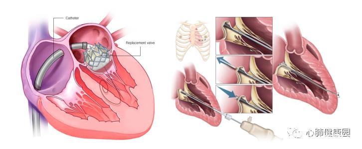 风湿性心脏瓣膜置换术
