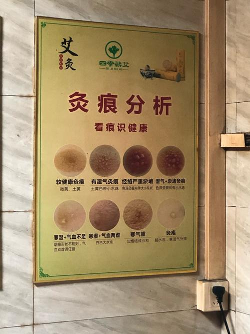 风湿灸治产后风有用吗