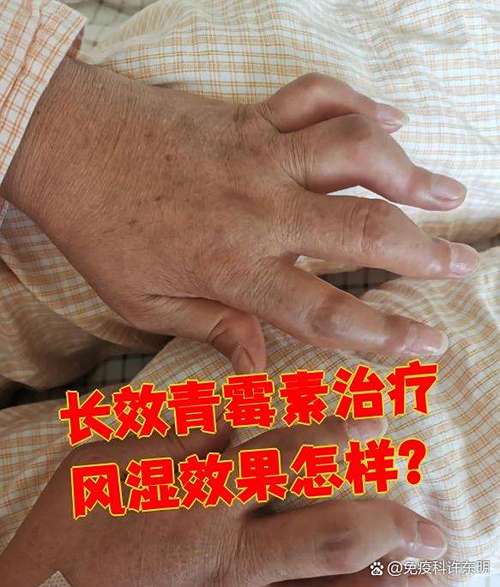 青霉素对风湿有作用吗