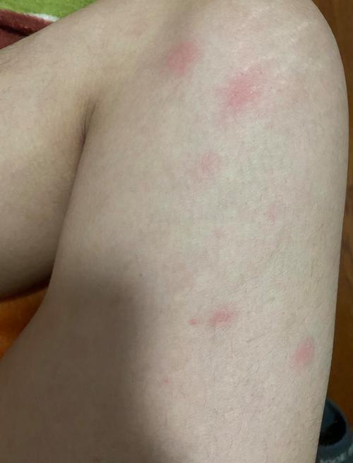 风湿性结节性红斑图片