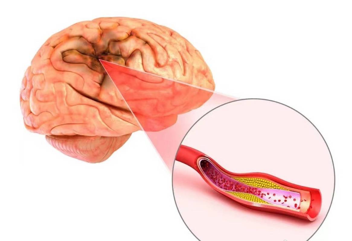 脑梗打了十天针没好转