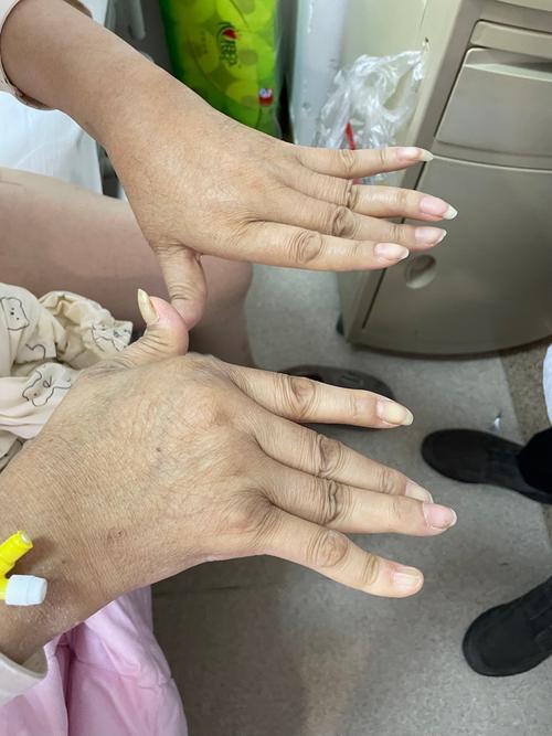 类风湿关节炎后期图片