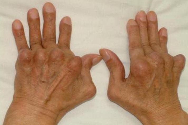 类风湿关节炎后期图片