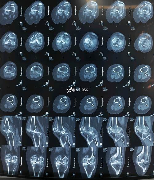 类风湿关节炎关节置换