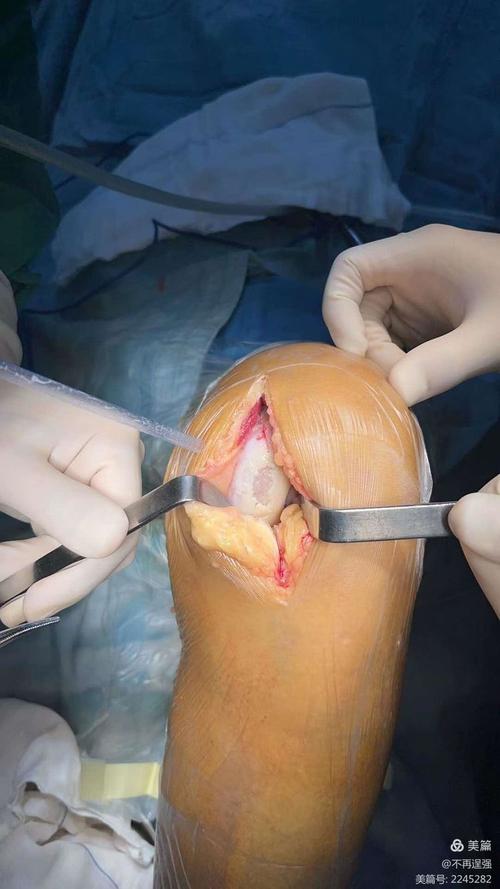 类风湿关节炎关节置换