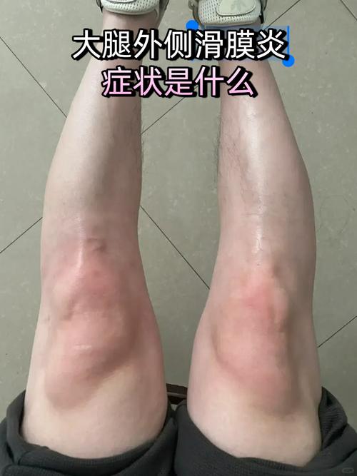 风湿性膝盖滑膜炎症状