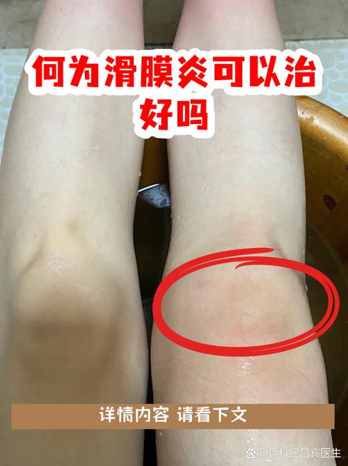 风湿性膝盖滑膜炎症状