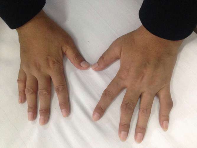 类风湿拍片能看出来吗