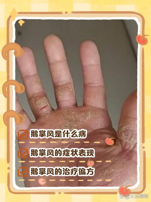 每天吹风扇风湿怎么办