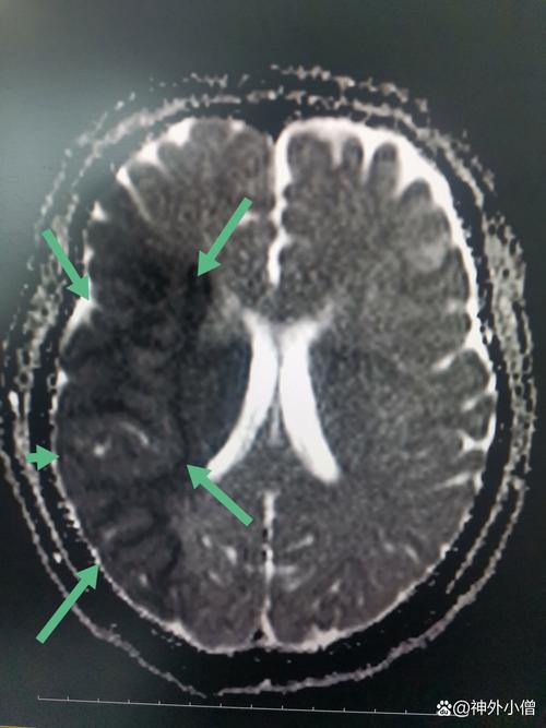 大面积脑梗无意识昏迷
