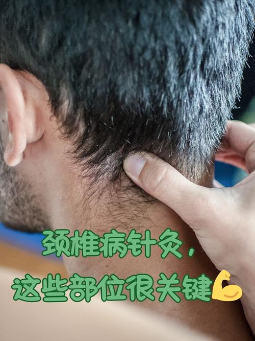 颈椎针灸需几个穴位