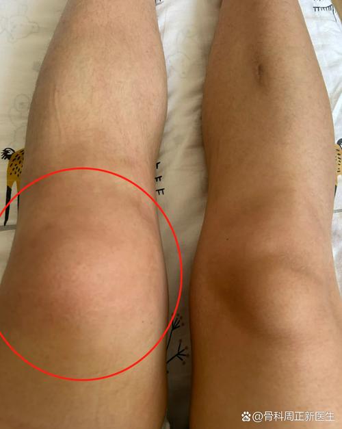 腿火辣辣的风湿严重不