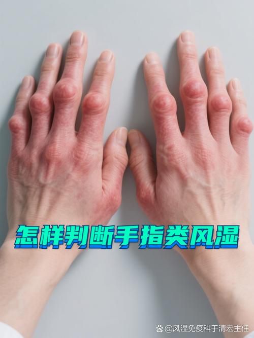 类风湿早期是多长时间