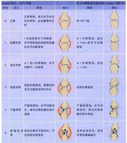 类风湿关节炎英文缩写