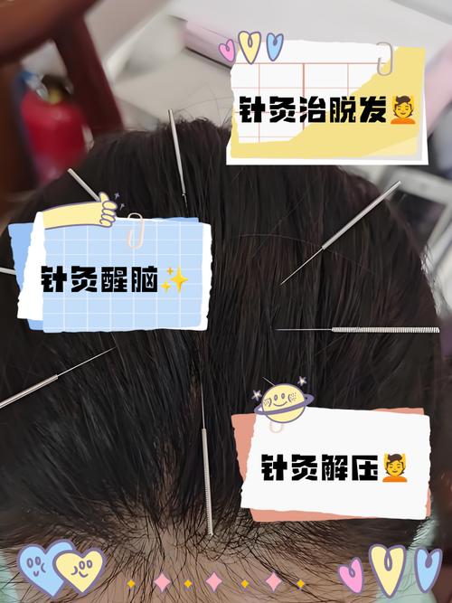 脑梗针灸后的注意事项