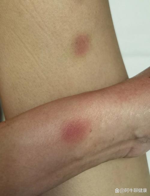 风湿性边缘性红斑图片