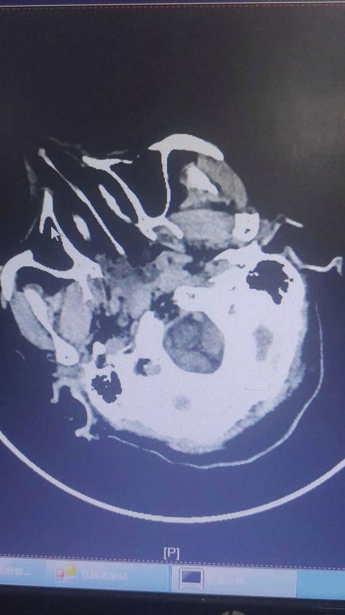 手术引发的大面积脑梗