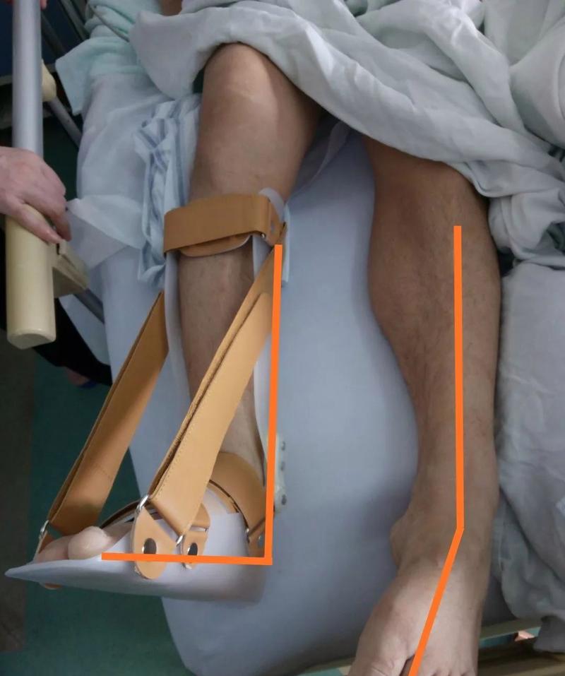 脑梗为何会出现脚内翻