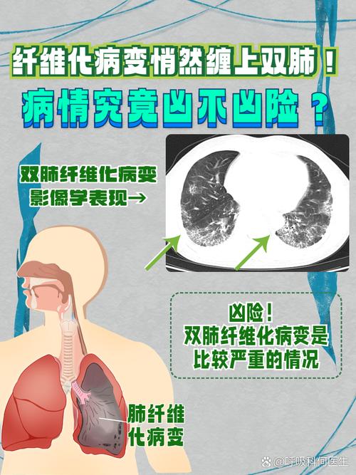 风湿性血管炎肺部感染