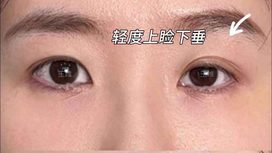 脑梗很多年后眼皮下垂