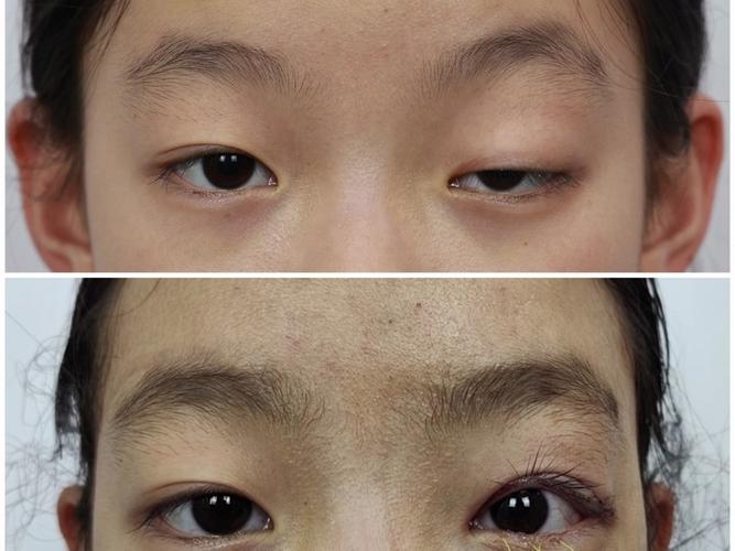 脑梗很多年后眼皮下垂