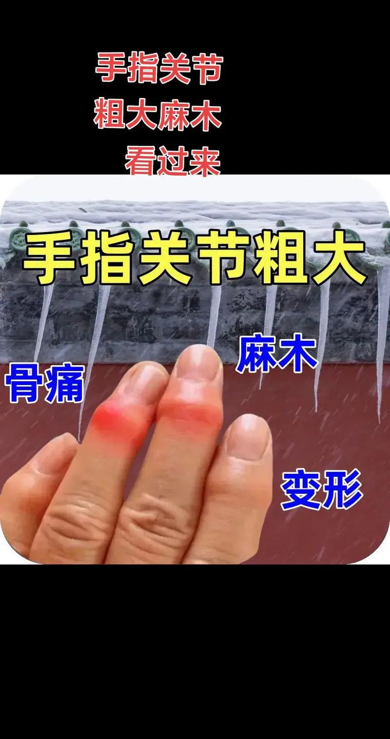 手指类风湿关节炎治疗