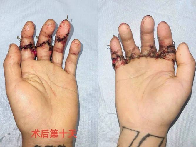 类风湿关节炎手指手术