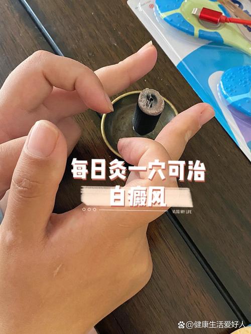 白癫风用哪些穴位灸