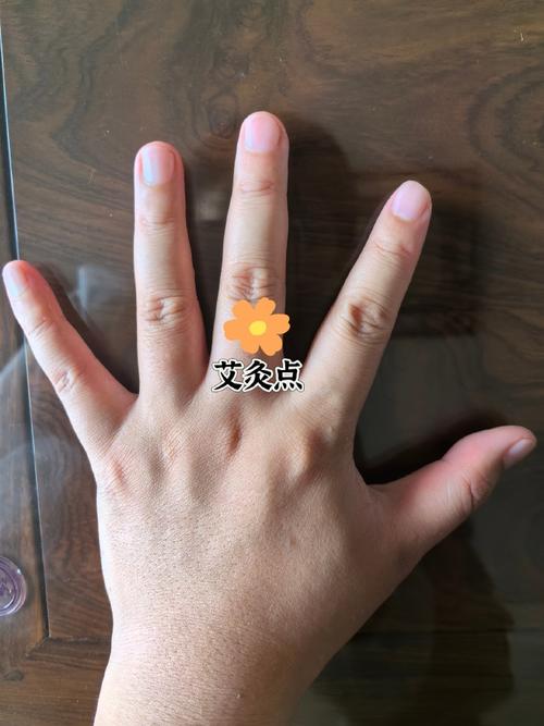 白癫风用哪些穴位灸