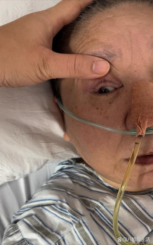 眼睛睁不开眼皮沉脑梗