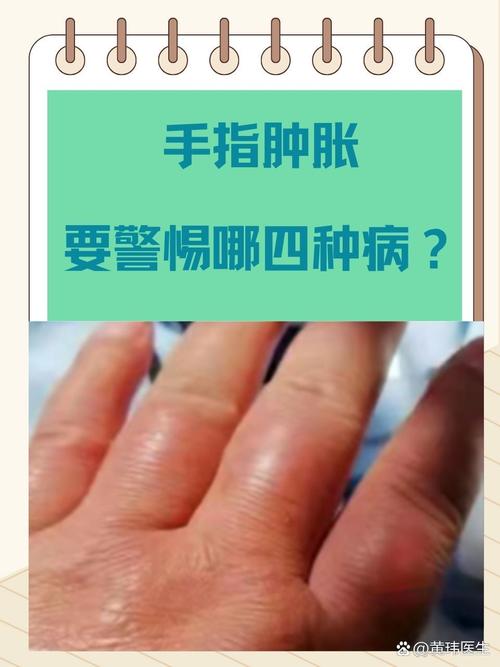 脑梗病人手肿怎么回事