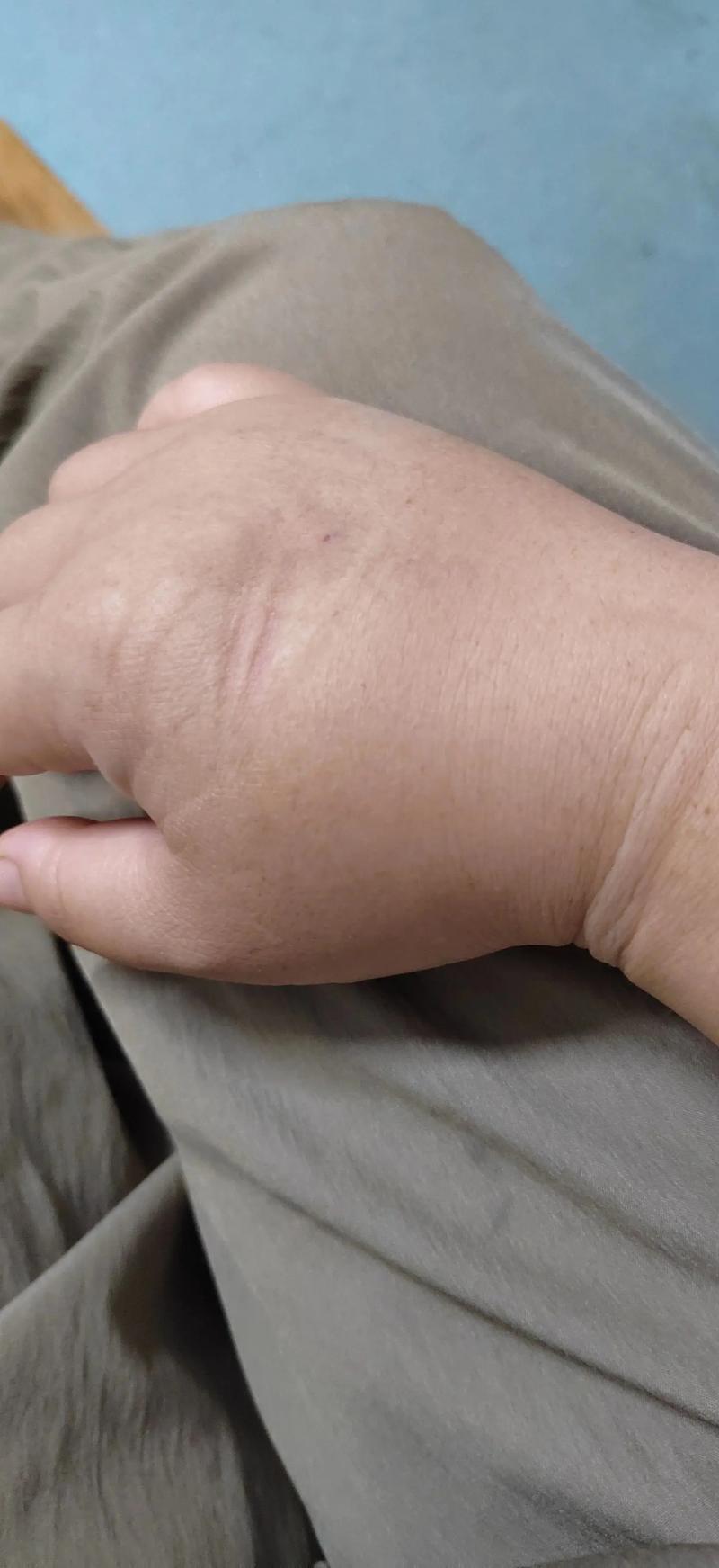 脑梗病人手肿怎么回事