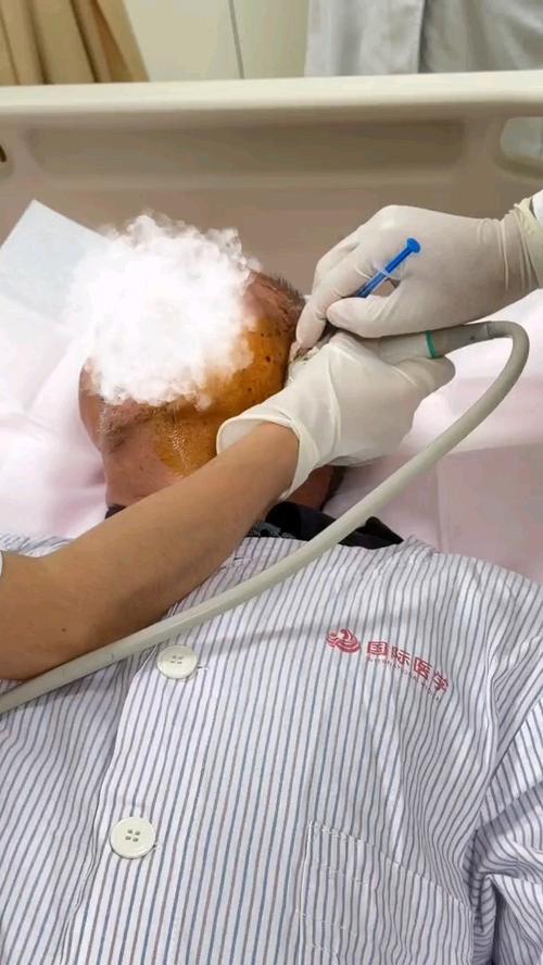 脑梗后流口水怎么治疗