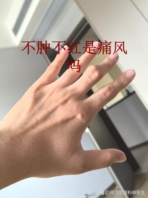 海南三亚关节炎 风湿