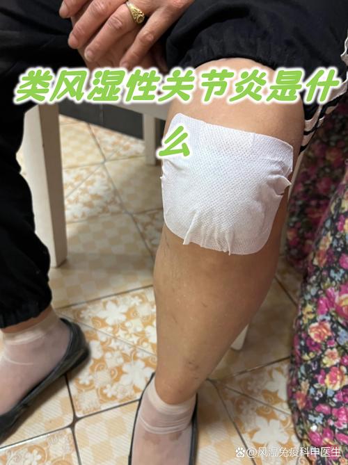 类风湿关节炎保守治疗