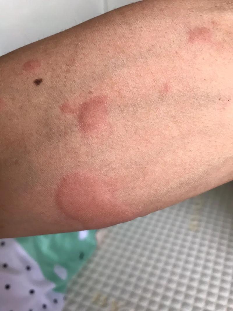 风湿病身上痒有关系吗