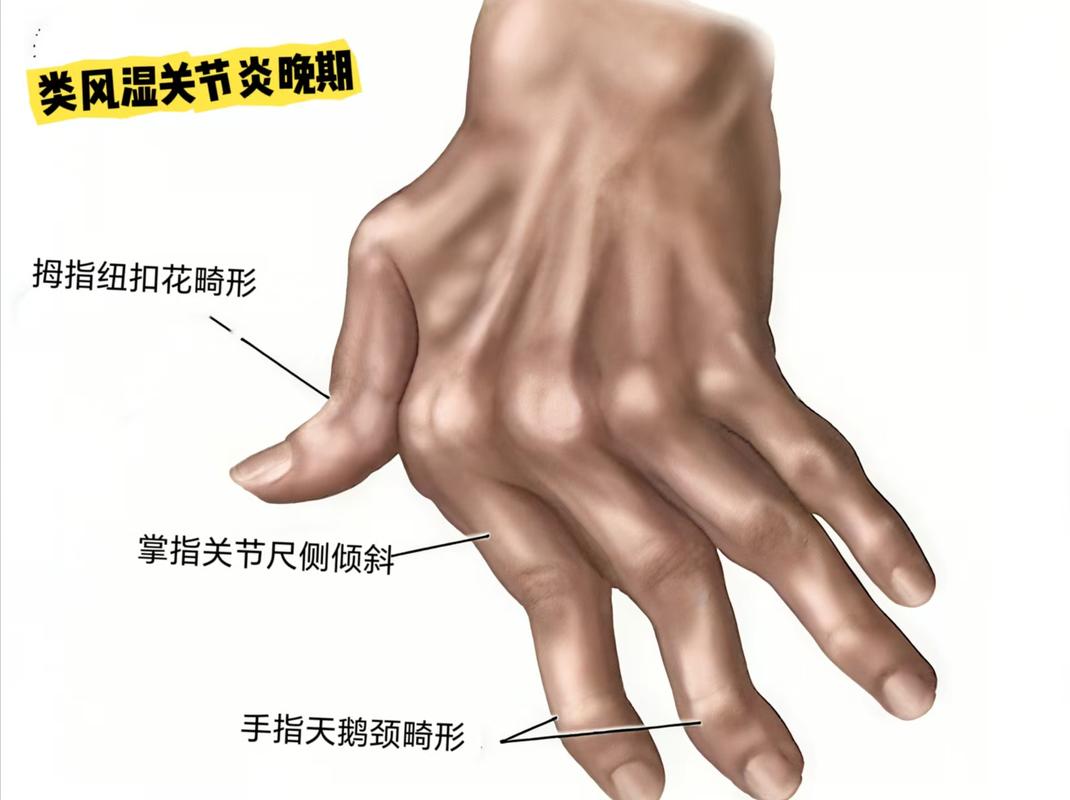 类风湿关节炎骨膜反应