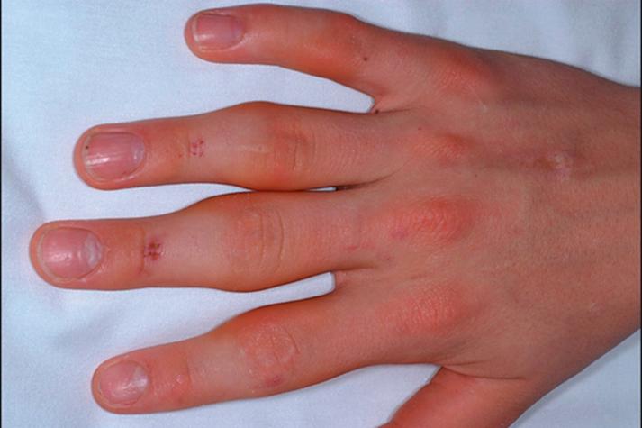 类风湿关节炎皮肤症状