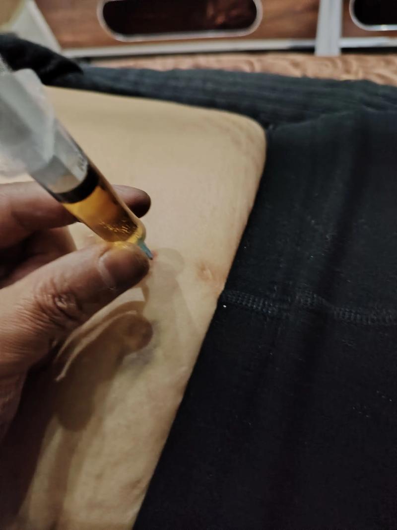 穴位注射有什么危害