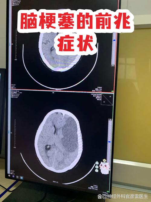 脑梗出院后复发的前兆