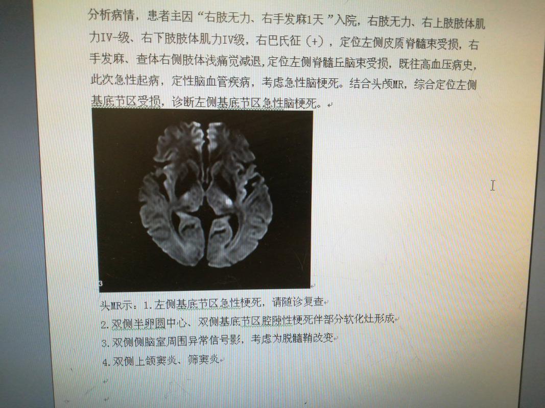 左侧基底节脑梗严重吗